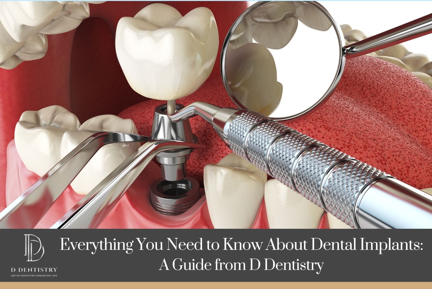 Everything You Need to Know About Dental Implants  A Guide from D Dentistry1